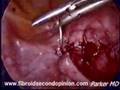 Laparoscopic Myomectomy