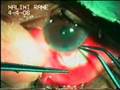 Glaucoma Surgery Glaucoma Surgery