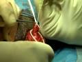 Vasectomy Reversal