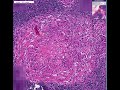 Histopathology Lymph node --Tuberculosis Histopathology Lymph node --Tuberculosis