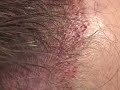 Dallas hair transplant:  male hairline variation