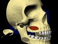 maxillary sinus lift