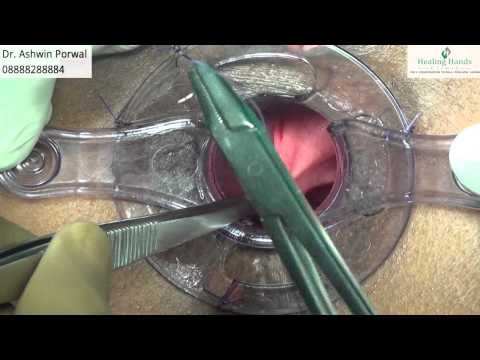 how to relieve post op constipation