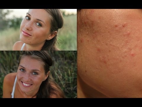 Как лечится экзема на пальцах рук