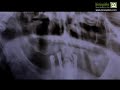 Implantes maxilar superiro e inferior- www.bicuspides.com Implantes maxilar superiro e inferior- www.bicuspides.com