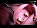 Implantes-maxilar-su