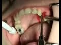 Non-Surgical Extraction Non-Surgical Extraction