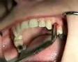 Non-Surgical Extraction