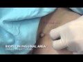 The Best 15 Inner Thigh Picture Of Groin Area In Female