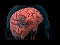 Stroke