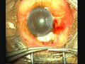 Trabeculeclectomy with MMC