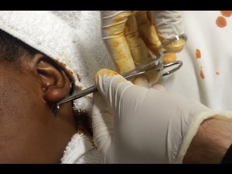 how to remove earrings