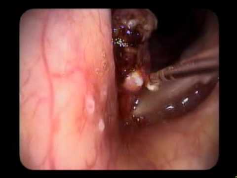 how to cure rrp