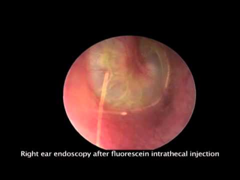 how to drain excess fluid from ear