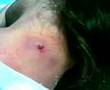 Absceso Ema