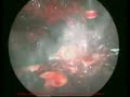 pembedahan laparoscopy endometriosis