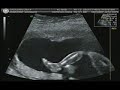 Baby Calicdan Ultrasound - 20 weeks Baby Calicdan Ultrasound - 20 weeks