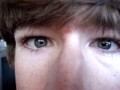 My Congenital Nystagmus and Astigmatism