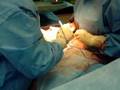 elective cesarean staples