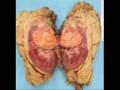 They Are All Types of Cancer.wmv