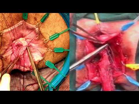 Elective versus emergency full thickness rectal prolapse treatment using a perineal approach