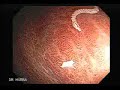 Worms in YOUR stomach.