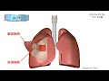胸膜炎/2分で分かる医療動画辞典 ミルメディカル 胸膜炎