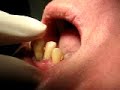 Periodontitis (gum disease) Periodontitis (gum disease)