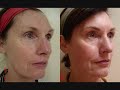 LASER SKIN REJUVENATION. FRACTIONAL CO2 LASER SKIN RESURFACING