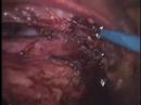 Laparoscopic Extraperitoneal Aortic Lymph Node Dissection Laparoscopic Extraperitoneal Aortic Lymph Node Dissection