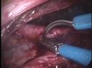 Laparoscopic Extraperitoneal Aortic Lymph Node Dissection  Chemotherapy Procedures and Therapies