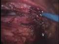 Laparoscopic Extraperitoneal Aortic Lymph Node Dissection