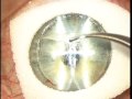 All Laser LASIK