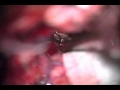 Clipping Of the Giant Aneurysm Of The Posterior Communicating Artery - Part 2 Clipping Of the Giant Aneurysm Of The Posterior Communicating Artery - Part 2