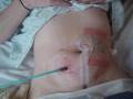 SURGICAL REVISION CATHETERISABLE STOMA
