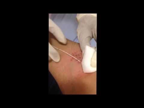 how to remove central line