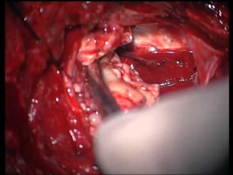 Amygdalohippocampectomy for intractable epilepsy (MTS)-trans middle temporal gyrus approach