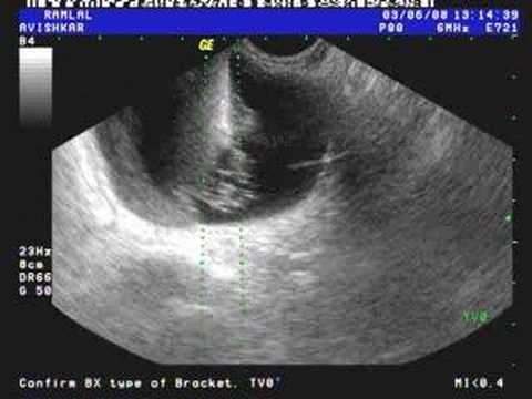 how to drain ovarian cyst