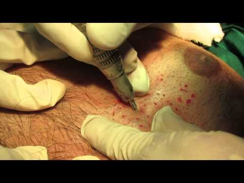how to hair transplant in india