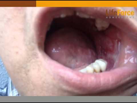 how to cure oral lichen planus
