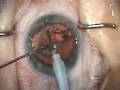 Modern Cataract Surgery