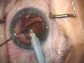 Modern Cataract Surgery