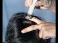 English Traditional Chinese Medicine Lesson  acupuncture and moxibustion V