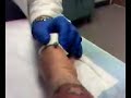 Broken Pinkie Pins Removed