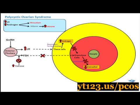 how to get rid of pcos naturally
