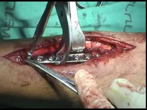 how to recover bone fracture