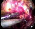 Correcci�n laparosc�pica del Defecto Paravaginal