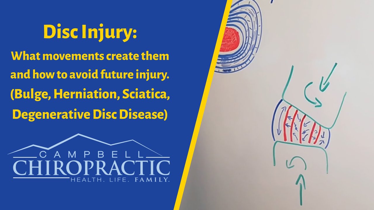 Centennial Chiropractor - What movements lead to disc injury and why, then how to avoid disc injury.