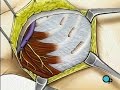 PreOp® Patient Education : Mastectomy Radical Surgery