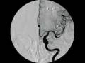 videos de BRAIN ANEURYSM - ANEURISMA CEREBRAL 2